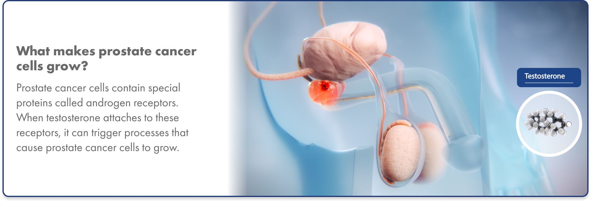 Prostate cancer cell and androgen receptor interaction Graphic of testosterone binding to androgen receptors in prostate cancer cells, causing them to multiply